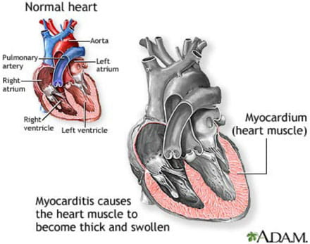 myocarditis heart symptoms causes pediatric inflammation children clinical muscle diagnosis manifestations treatment disease chest medlineplus physical pain infection health normal